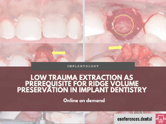 Low trauma extraction as prerequisite for ridge volume preservation in implant dentistry